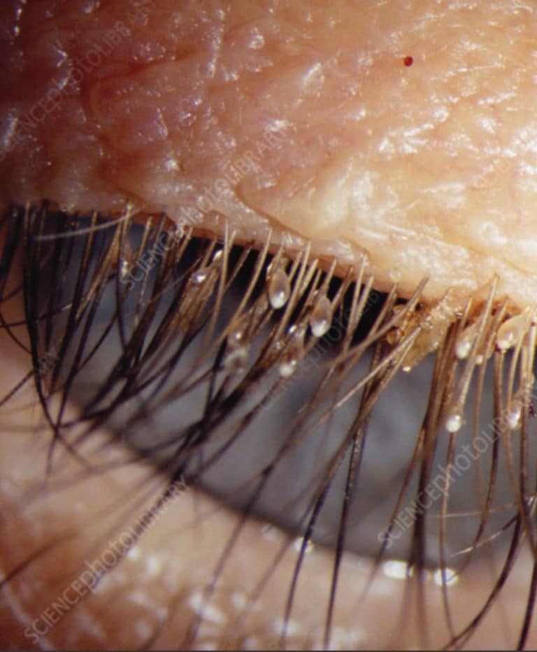 images of lice in hair