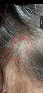 Close-up of a persons scalp with thinning hair. A red circle highlights a small bald spot among dark hair strands.